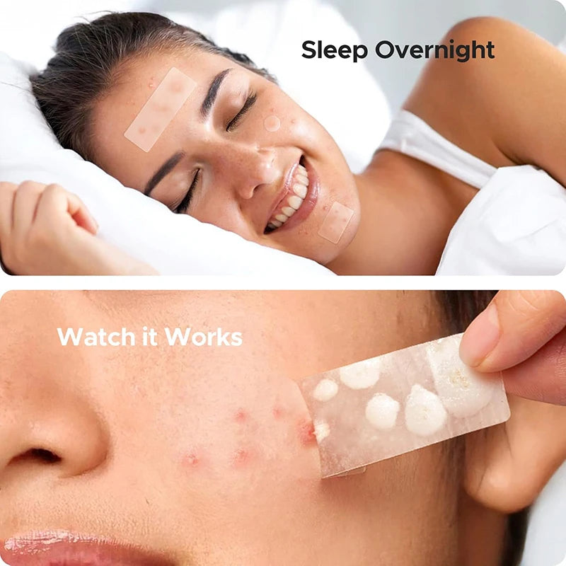 302Pcs Invisible Waterproof Acne Patches
