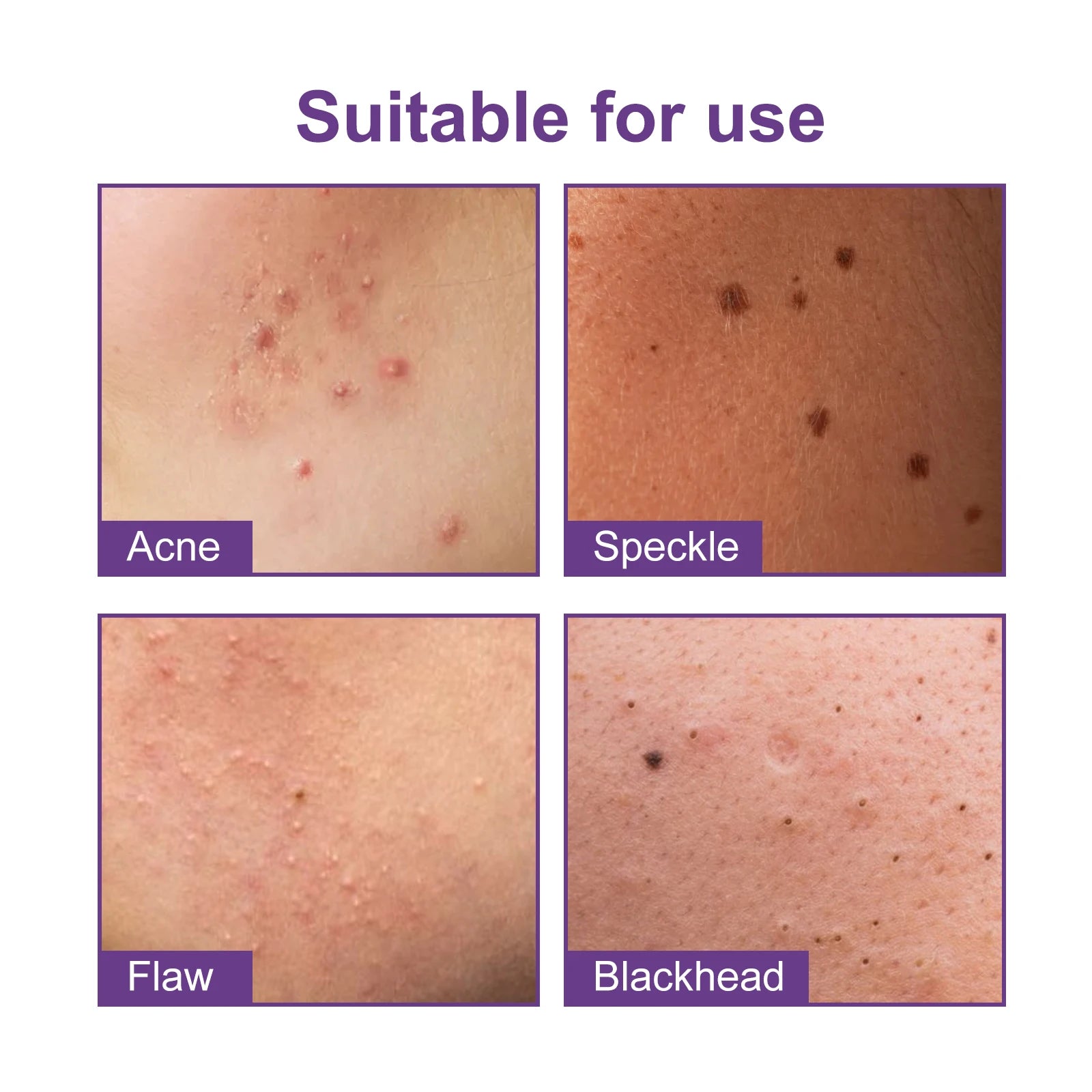 180Pcs Water Gel Acne Patch Set